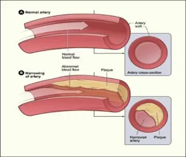 Artery clogging